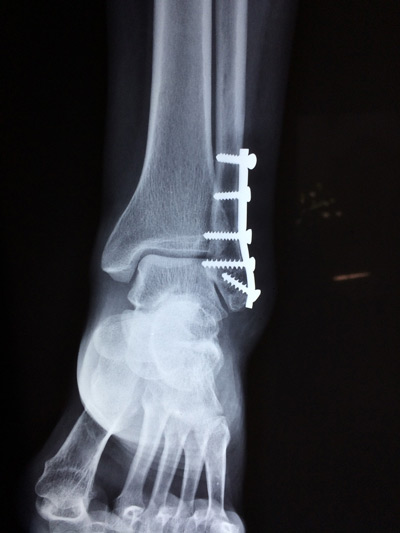 Ankle Fracture X-ray
