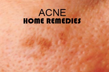 13 Home Remedies For Acne And Pimples
