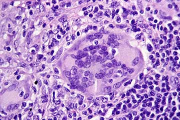Granulomas in an intestinal lymph node in Crohn's disease