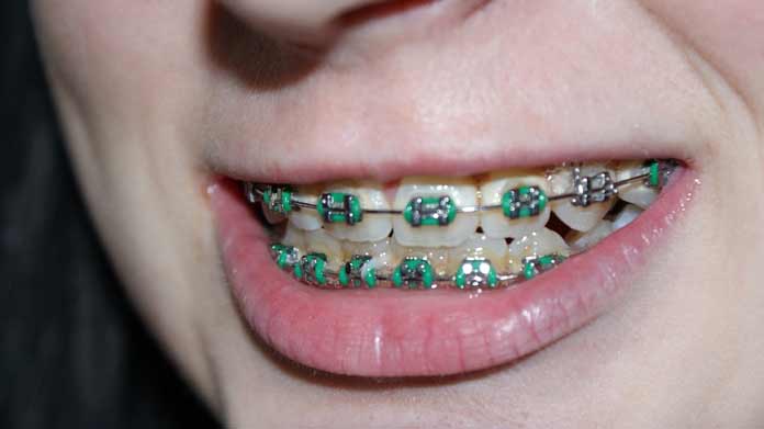 Teeth-Braces