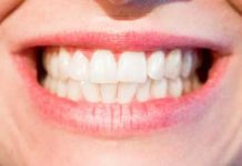 6 Things to Consider Before Getting Aligners for Your Teeth Teeth-and-Gums-Health