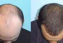 FUE Hair Transplant: Advanced Procedure For Restoring Hairs Hair Transplant To Treat Hair Loss