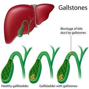 Prevention of gall bladder stones with lecithin granules and other food products 3