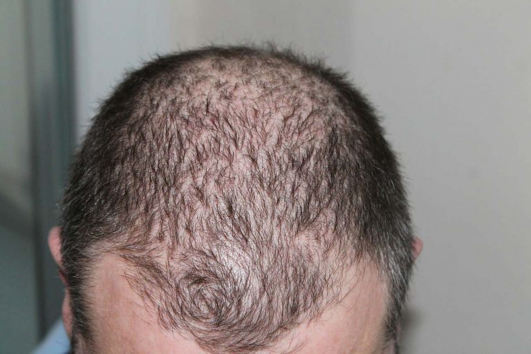 How FUE hair transplant is effective and provide best results